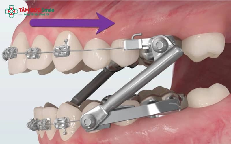 Quá trình này giúp răng di chuyển an toàn, đồng thời duy trì cấu trúc xương ổn định
