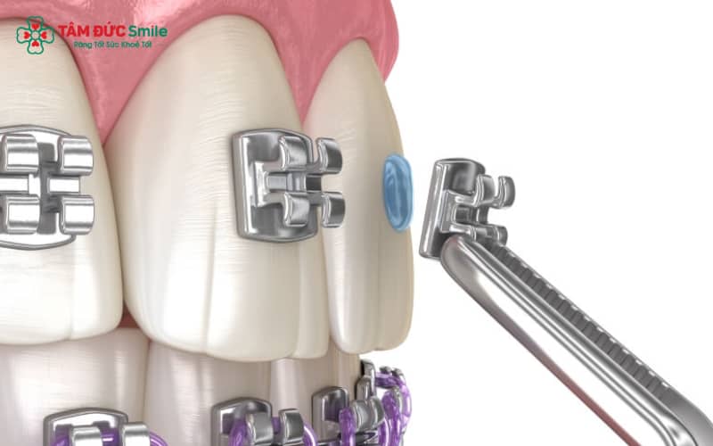 Mắc cài kim loại giúp răng dịch chuyển hiệu quả với chi phí hợp lý