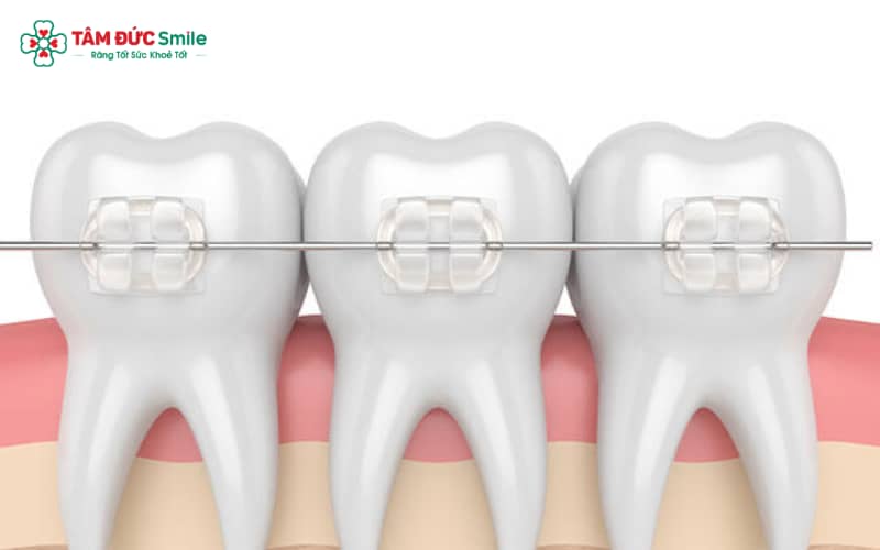 Mắc cài sứ giúp Abc87 tải ứng dụng Abc8c1 com khuyến mãi hấp dẫn, gần như vô hình khi giao tiếp