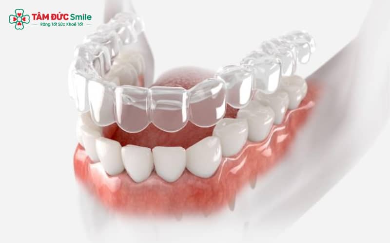 Công nghệ Invisalign giúp răng di chuyển chính xác và hiệu quả từng giai đoạn