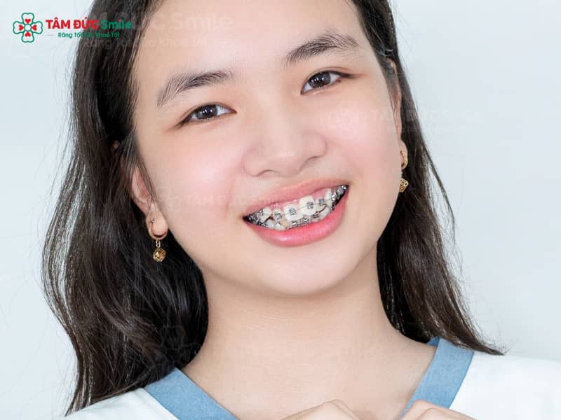 Quý khách ở độ tuổi 12–18 là giai đoạn lý tưởng để sắp đều răng và tối ưu khớp cắn