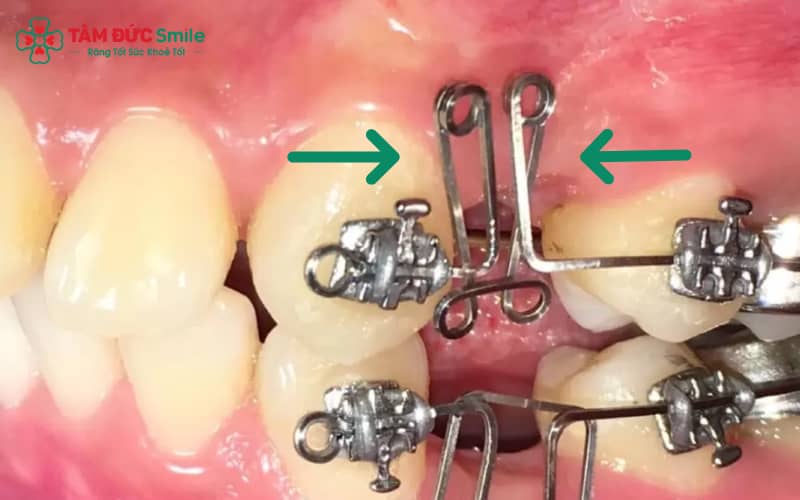 Cơ chế đóng khoảng giúp dịch Link Vào Abc8.com Đăng Ký Tặng 88K về đúng vị trí