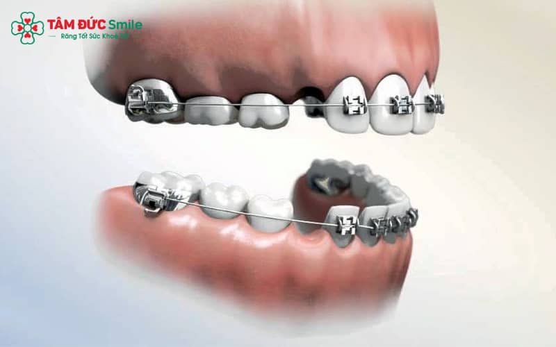 Đóng khoảng không nhổ răng phù hợp với các trường hợp răng thưa nhẹ, ít chen chúc.