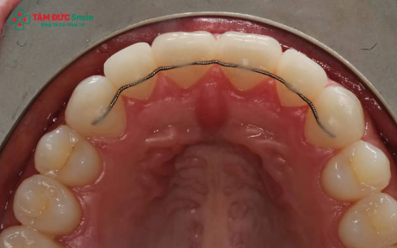 Hàm duy trì cố định thường được gắn ở mặt trong răng cửa hàm trên hoặc hàm dưới