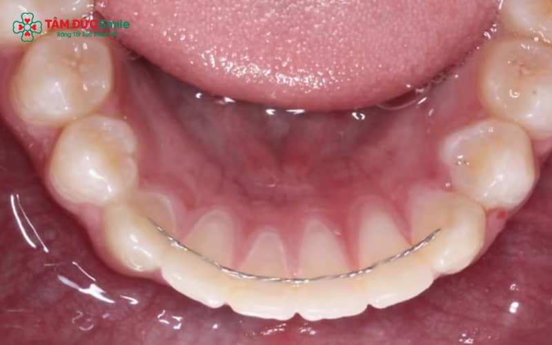 Dây cố định giúp giữ răng ổn định, không bị dịch chuyển sau khi tháo niềng