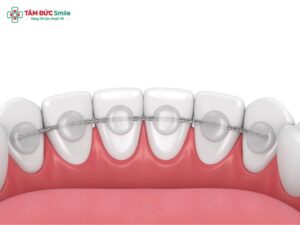 Hàm duy trì cố định: Ưu nhược điểm, thời gian đeo, chi phí & cách vệ sinh