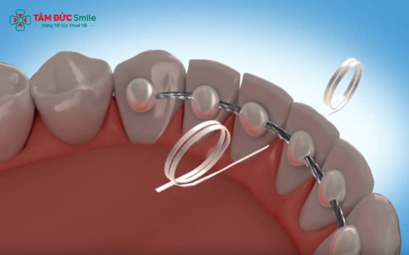 So với hàm cố định, hàm duy trì tháo lắp gây bất tiện hơn trong việc vệ sinh