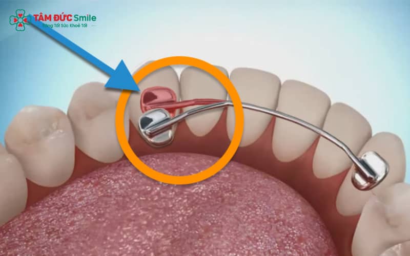 Khi dây cố định bị bong hoặc tuột, Quý khách nên liên hệ ngay với phòng khám