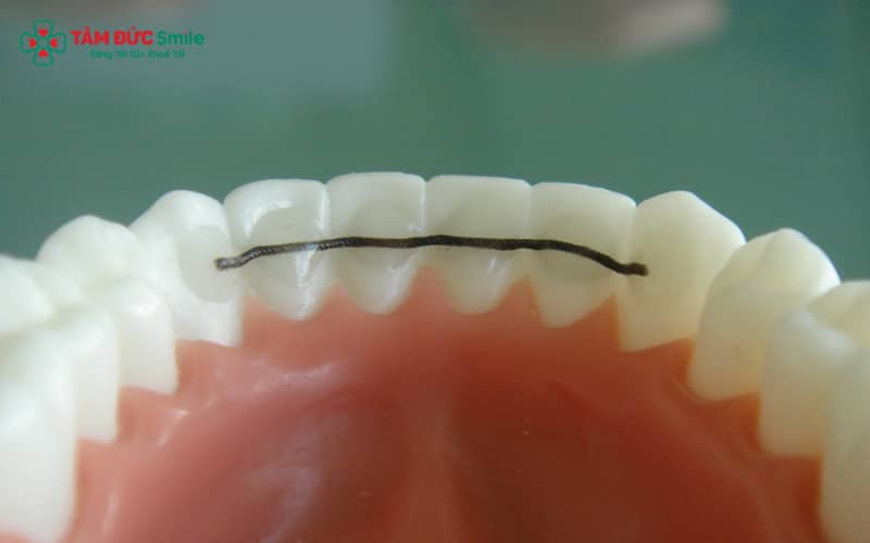 Hàm duy trì cố định mang lại hiệu quả giữ răng ổn định vượt trội