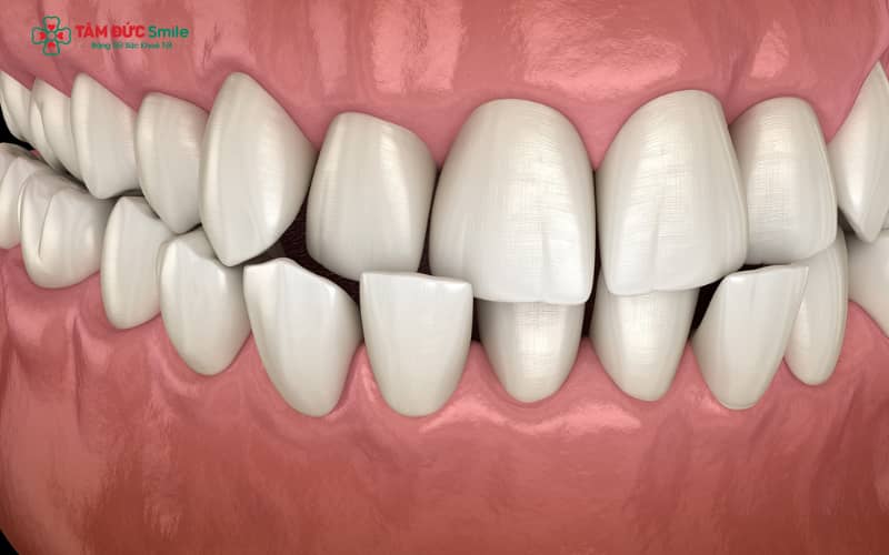 Tình trạng khớp cắn chéo hình thành khi hàm trên và hàm dưới lệch trục khớp