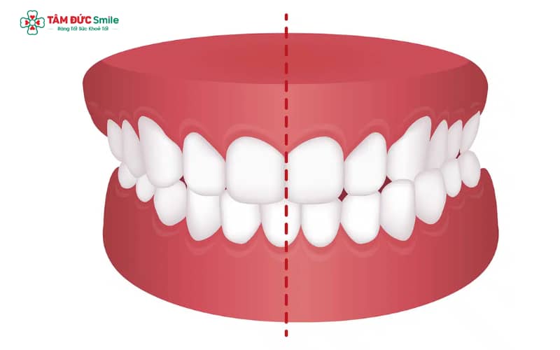 Những thói quen xấu hình thành sớm thường xuyên có thể làm lệch khớp cắn