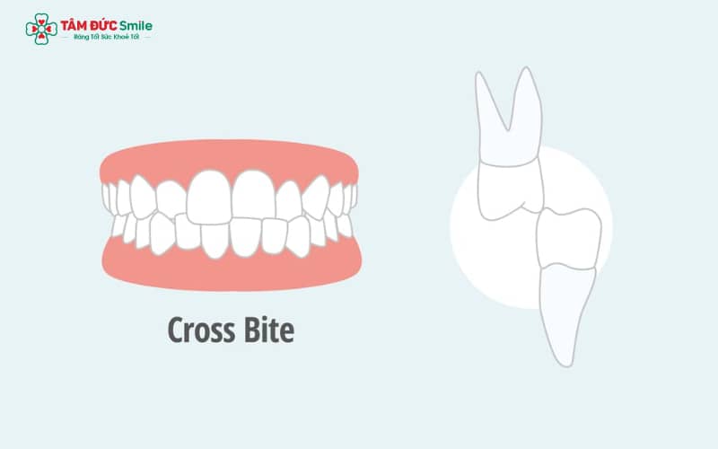 Sai lệch khớp cắn khiến lực nhai tập trung không đều, ảnh hưởng đến chức năng răng
