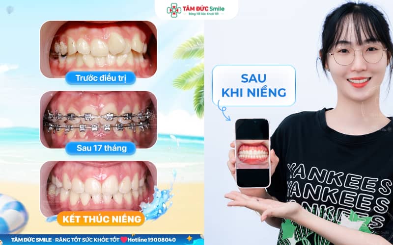 Mắc cài kim loại giúp Abc888k vip truy cập nhanh hiệu quả cho những ca khớp cắn chéo khó