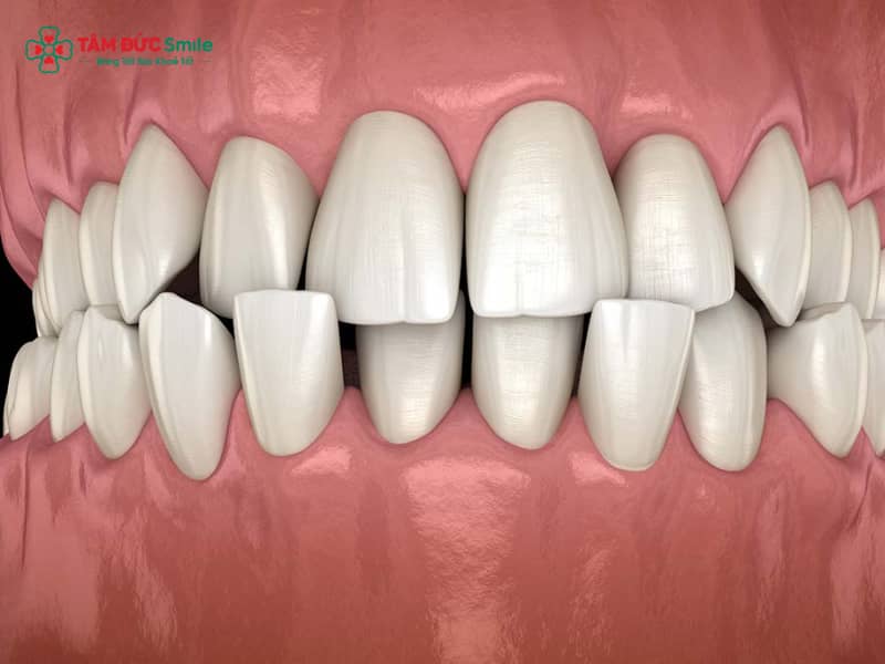 Khớp cắn chéo: Nguyên nhân, triệu chứng & cách Abc87 tải ứng dụng Abc888k vip truy cập nhanh hiệu quả
