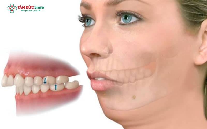 Lệch hàm là hiện tượng hàm trên và hàm dưới không phát triển hài hòa