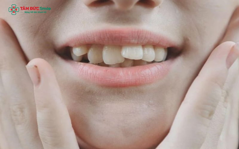 Hàm lệch rõ rệt gây mất cân đối khuôn mặt, khiến đường nét trở nên méo lệch