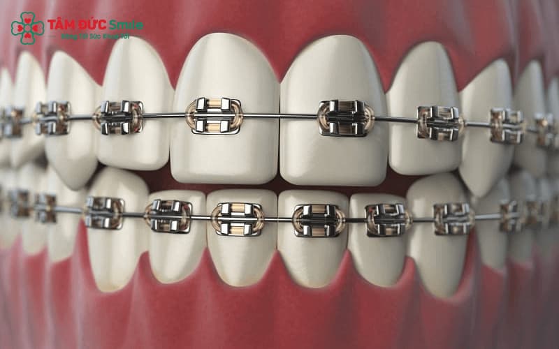 Mắc cài là khí cụ LINK TRANG CHỦ ABC88 CHUẨN 2026 được gắn trực tiếp lên răng trong quá trình niềng
