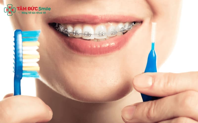 Chăm sóc răng niềng đúng cách với dụng cụ chuyên dụng