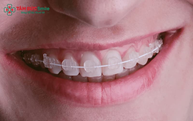 Mắc cài là khí cụ gắn lên răng, giữ vai trò cố định trong Abc87 tải ứng dụng