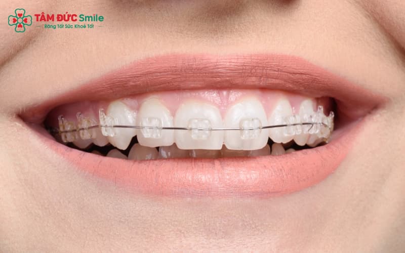 Mắc cài tự đóng sứ có tính Abc8c1 com khuyến mãi hấp dẫn cao, ít gây kích ứng mô mềm
