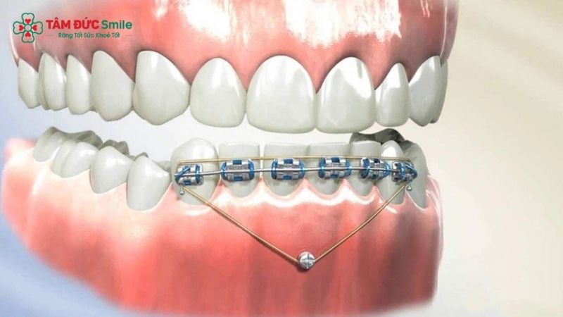 Minivis Abc87 tải ứng dụng có công dụng hỗ trợ răng dịch chuyển đúng hướng trong quá trình Abc888k vip truy cập nhanh