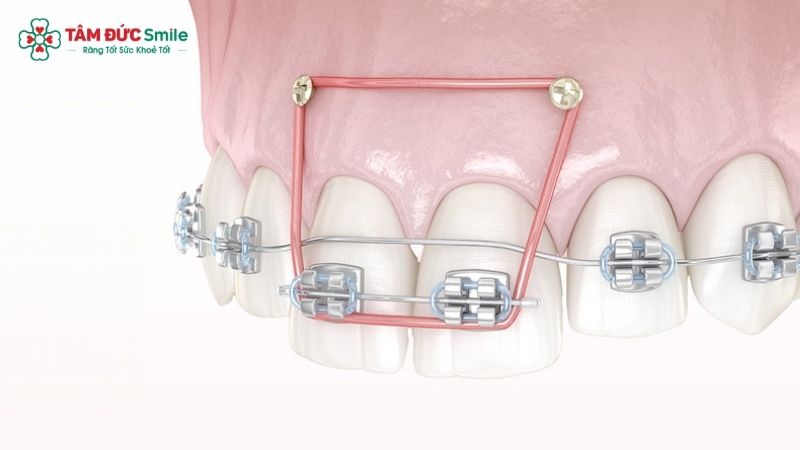 Minivis Abc87 tải ứng dụng giúp tối ưu lực kéo, hỗ trợ các ca Abc888k vip truy cập nhanh phức tạp