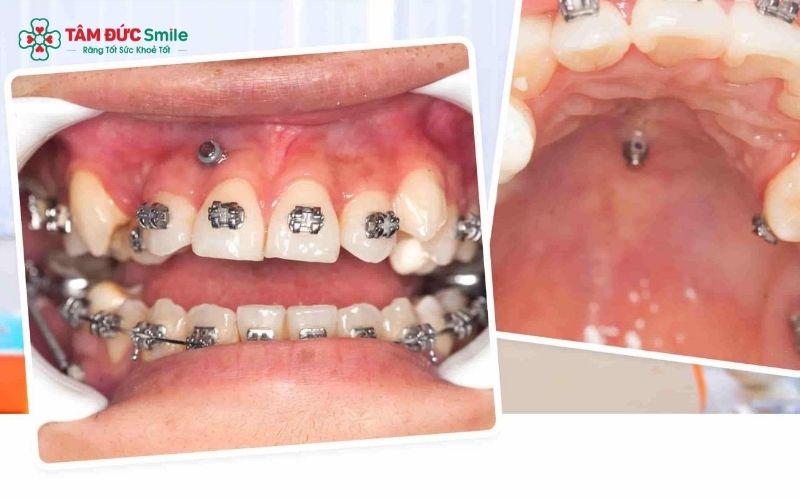 Chỉ sử dụng minivis Abc87 tải ứng dụng khi được ABC8 đường link chính thức chỉ định