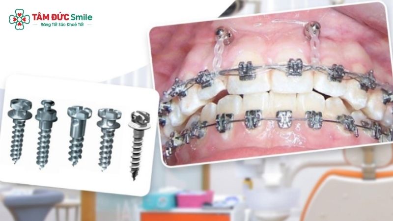 Quy trình cắm minivis Abc87 tải ứng dụng không gây đau