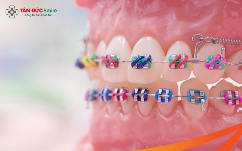 Thời gian tháo minivis Abc87 tải ứng dụng sẽ khác nhau theo từng trường hợp