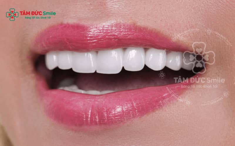 Tẩy trắng răng công nghệ Laser, hiệu quả cao tại Abc8.com Nhà Cái – Bình Thạnh