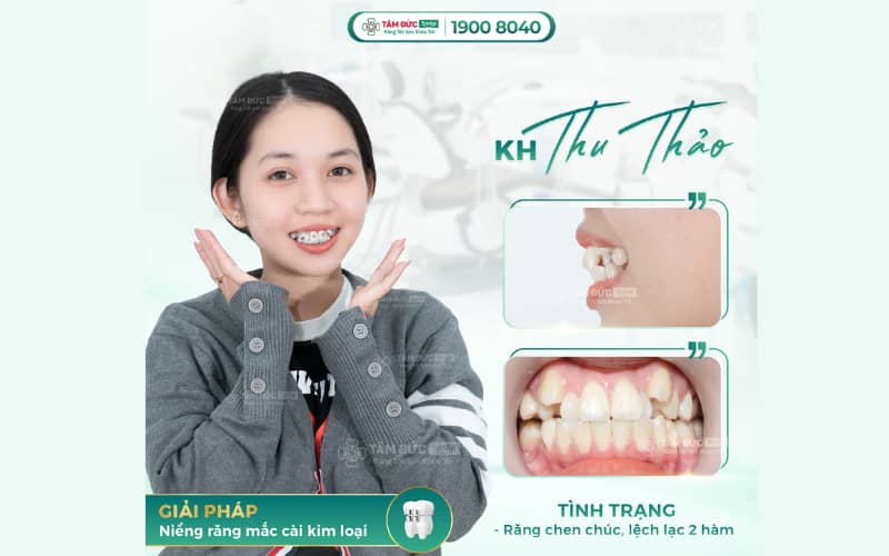 ABC8 được thành lập vào năm 2011 hoạt động đến hiện tại mắc cài kim loại giúp cải thiện khớp cắn hiệu quả với chi phí tối ưu