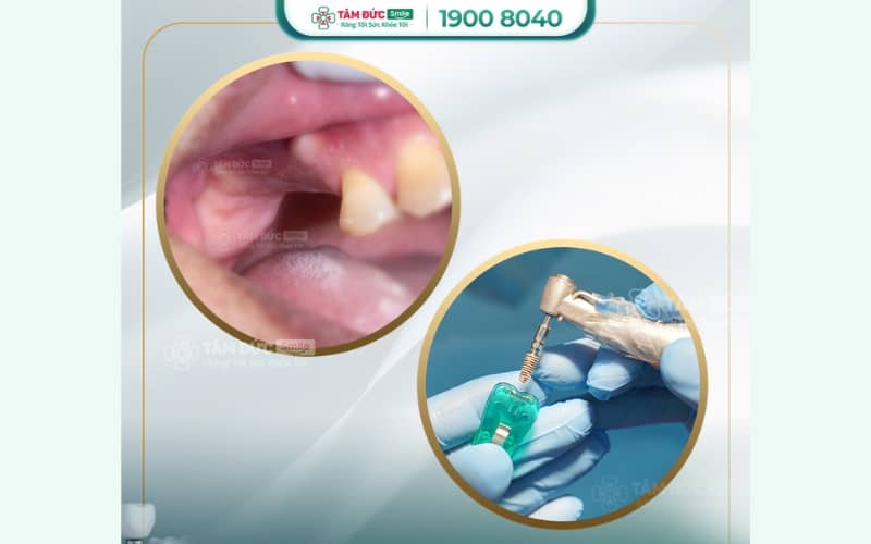ABC8 đường link chính thức tại Hóc Môn giúp khôi phục răng mất bền vững