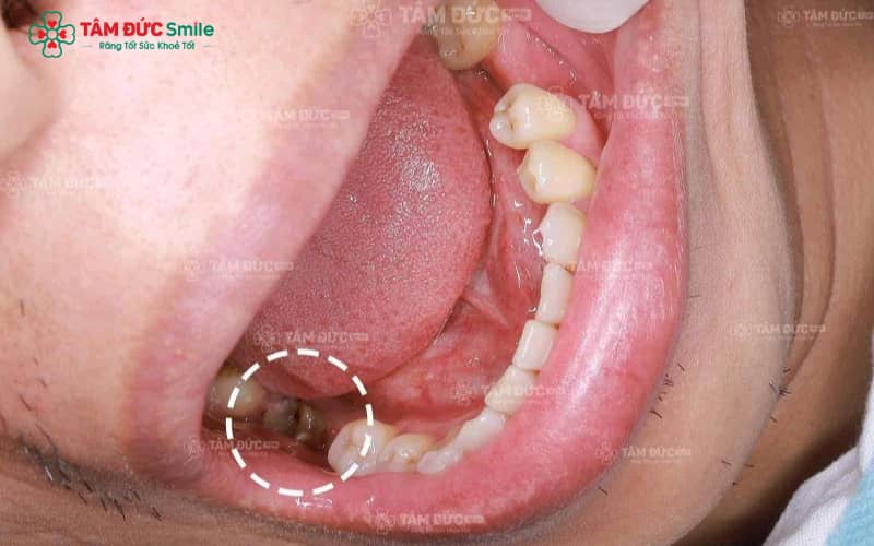 Chữa tủy không đau, phục hình răng Abc8c1 com khuyến mãi hấp dẫn tại Abc8.com Nhà Cái