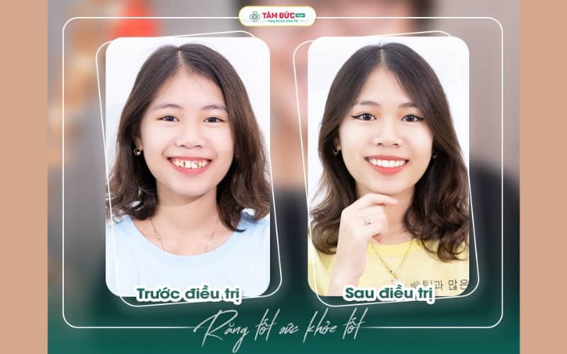 Abc8c1 com được cấp phép bởi PAGCOR Philippines Abc8c1 com khuyến mãi hấp dẫn giúp cải thiện răng xỉn màu, ố vàng