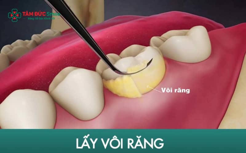 Cạo vôi răng giúp loại bỏ mảng bám cứng đầu