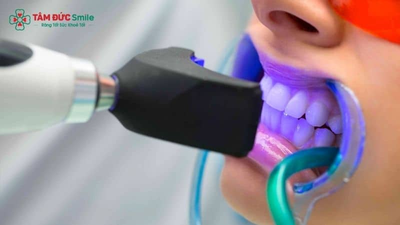 Công nghệ Laser giúp tẩy trắng răng hiệu quả và nhanh chóng