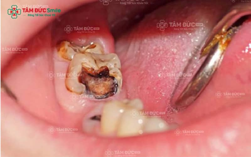 Chữa tủy và phục hình răng an toàn, nhẹ nhàng, không ê buốt tại ABC8 ✅ Truy Cập Nhà Cái ABC8 Com Cá Cược Tặng 88k Vũng Tàu