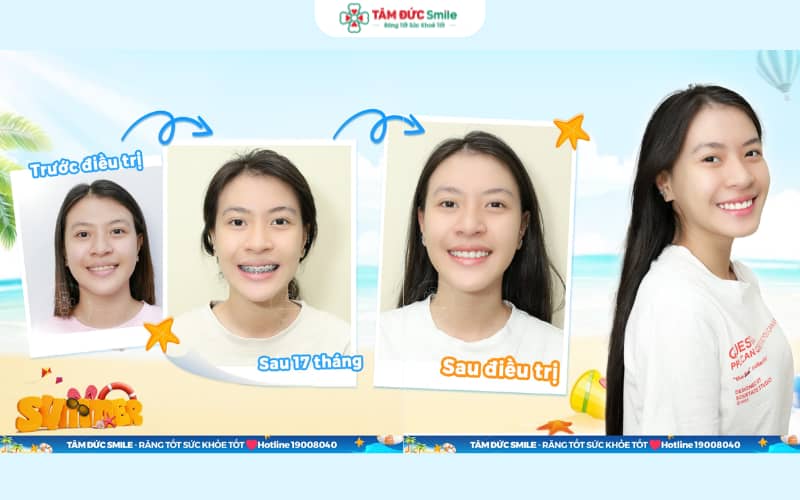 Chỉnh nha mắc cài kim loại mang lại ABC8 được thành lập vào năm 2011 hoạt động đến hiện tại đều đẹp, chi phí tối ưu