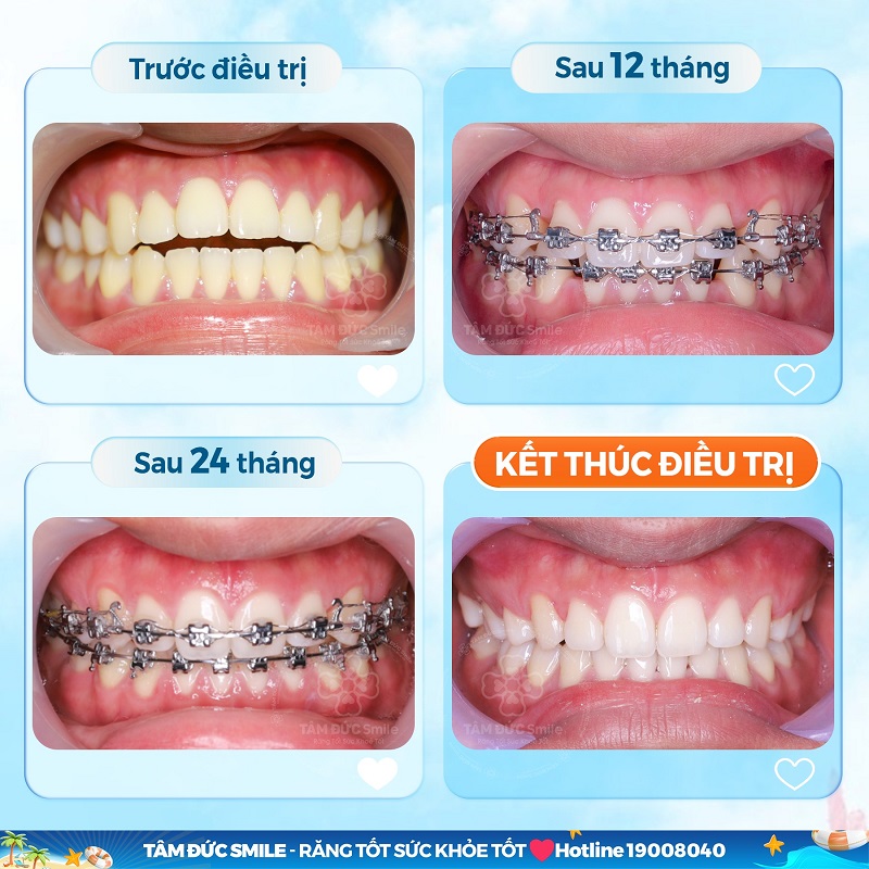 nieng-rang-binh-tan-2