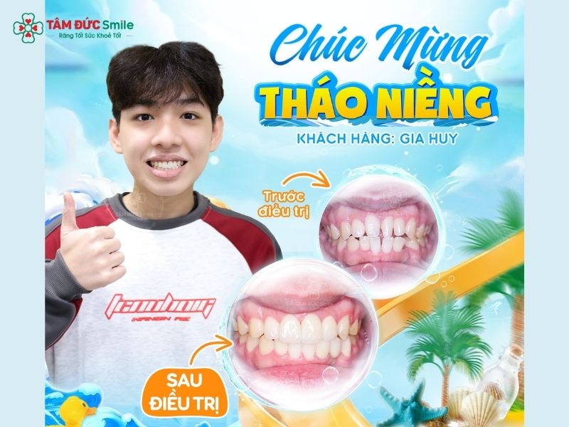 Hàm răng đều đẹp giúp cải thiện Abc8c1 com khuyến mãi hấp dẫn, chức năng ăn nhai và sự tự tin