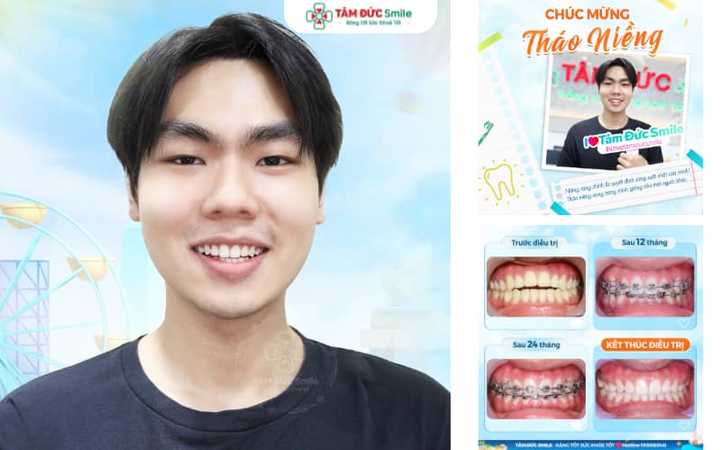 ABC8 được thành lập vào năm 2011 hoạt động đến hiện tại mắc cài kim loại giúp răng đều đẹp với chi phí tối ưu