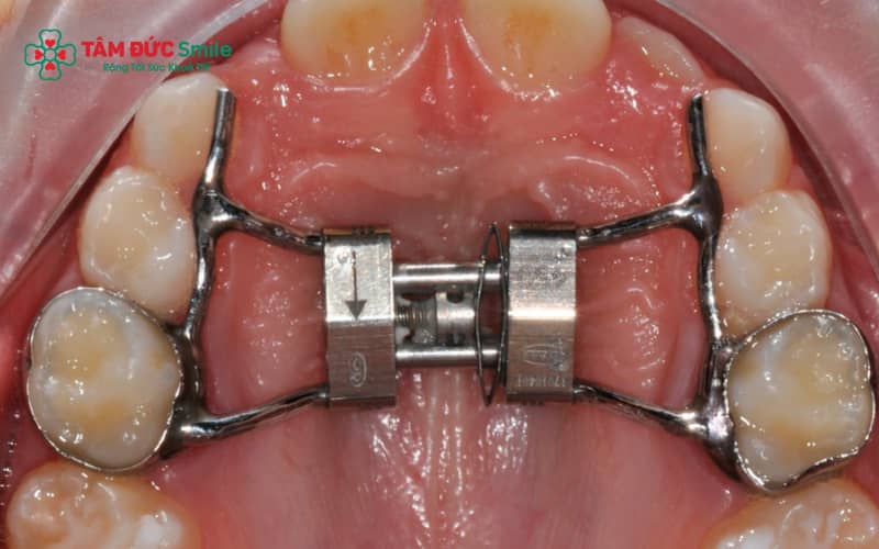 Nong hàm trước giai đoạn niềng hỗ trợ răng sắp xếp chuẩn vị trí nhanh hơn