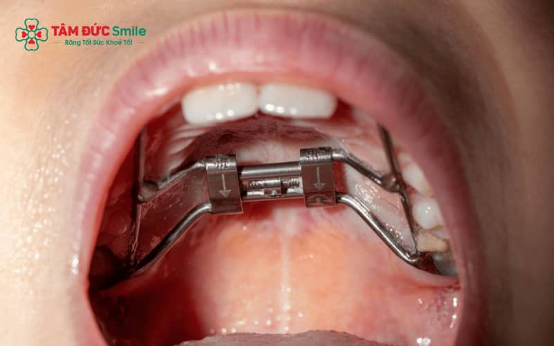 Nong hàm cố định áp dụng khí cụ gắn chặt vào răng để mở rộng cung hàm