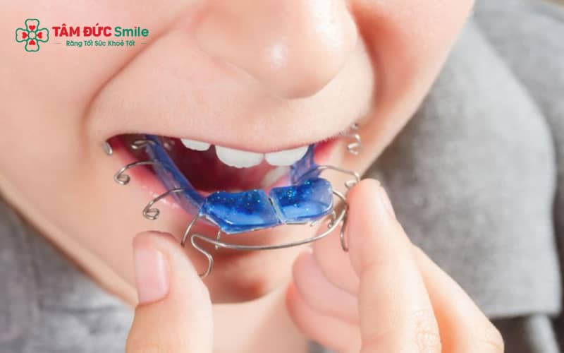 Khí cụ nong hàm tháo lắp cho phép tháo ra – lắp vào thuận tiện