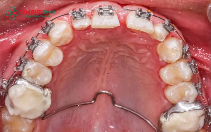 Kết hợp nong hàm và Abc87 tải ứng dụng giúp răng di chuyển thuận lợi, đạt khớp cắn chuẩn