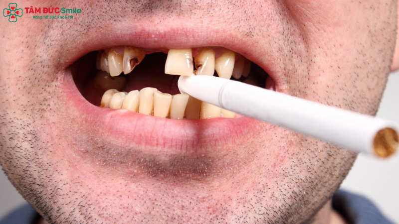 phong-ngua-nhiem-trung-implant-1