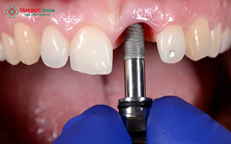 phong-ngua-nhiem-trung-implant-2