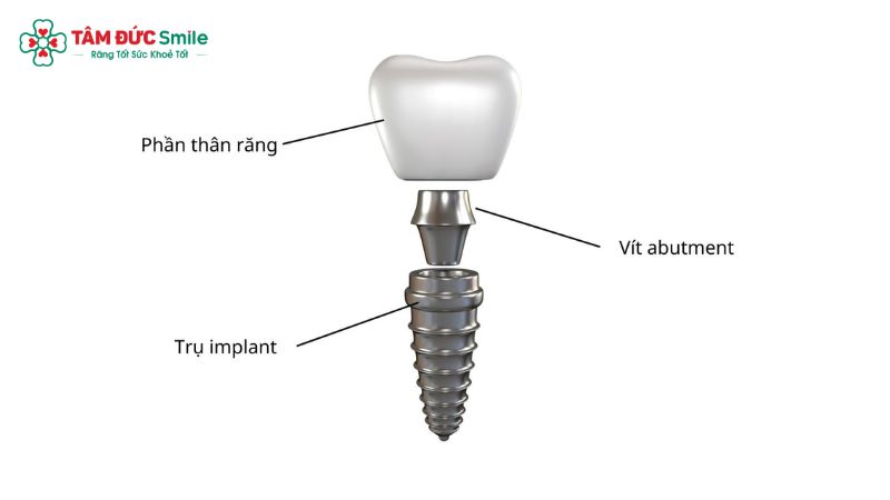 phuc-hoi-an-nhai-sau-implant-1