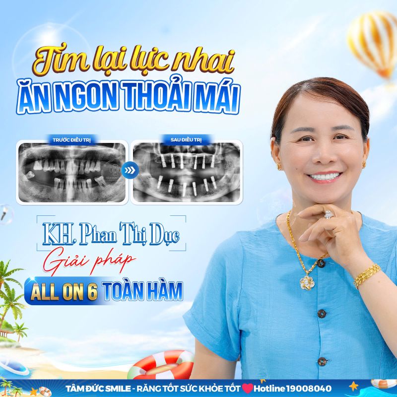 phuc-hoi-an-nhai-sau-implant-2