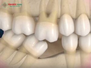 Nguyên nhân răng chạy lại sau khi tháo niềng và cách khắc phục hiệu quả